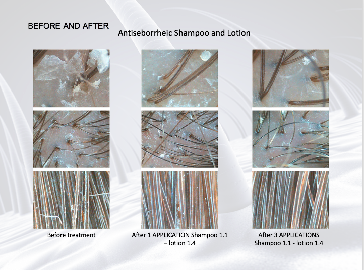 Antiseborheic Shampoo<br>Antiszeborreás sampon, viszketés és hajhullás ellen <br>500 ml, kód 1.1L